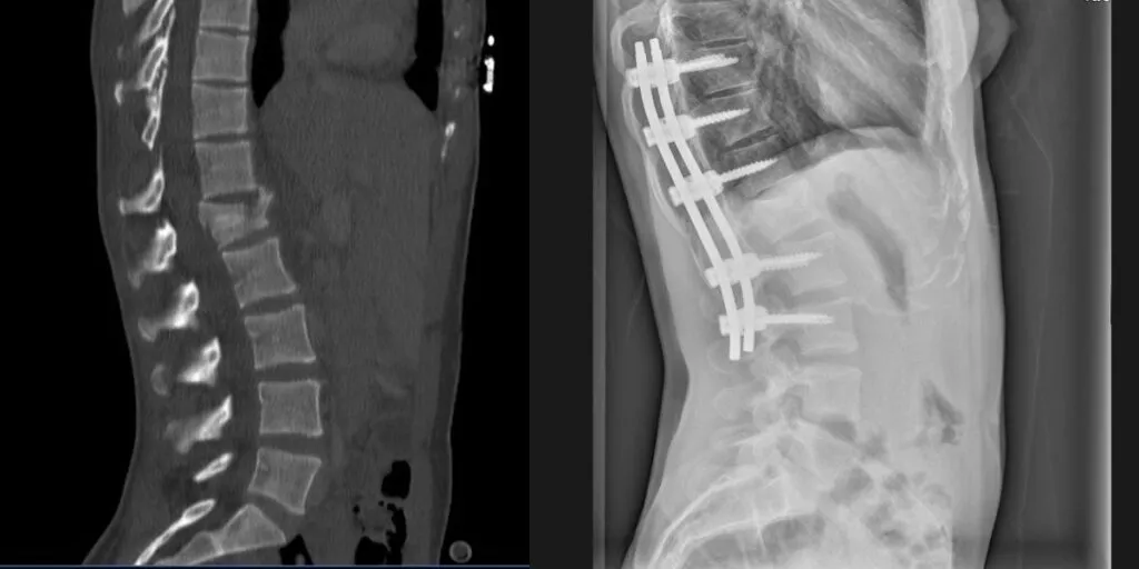 Fractura Vertebral Zaragoza